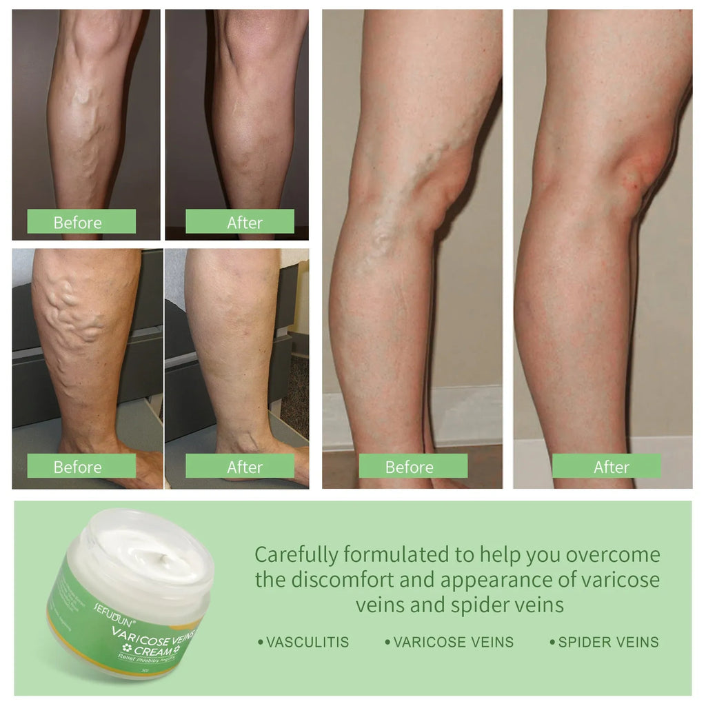 50g pot of vein cream with natural ingredients for varicose vein relief