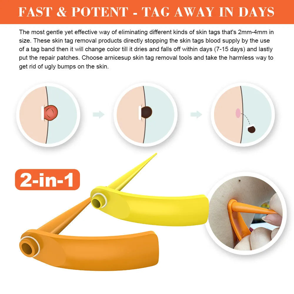 Orange yellow wart removal tool kit with devices, rubber rings, alcohol swabs, and stickers