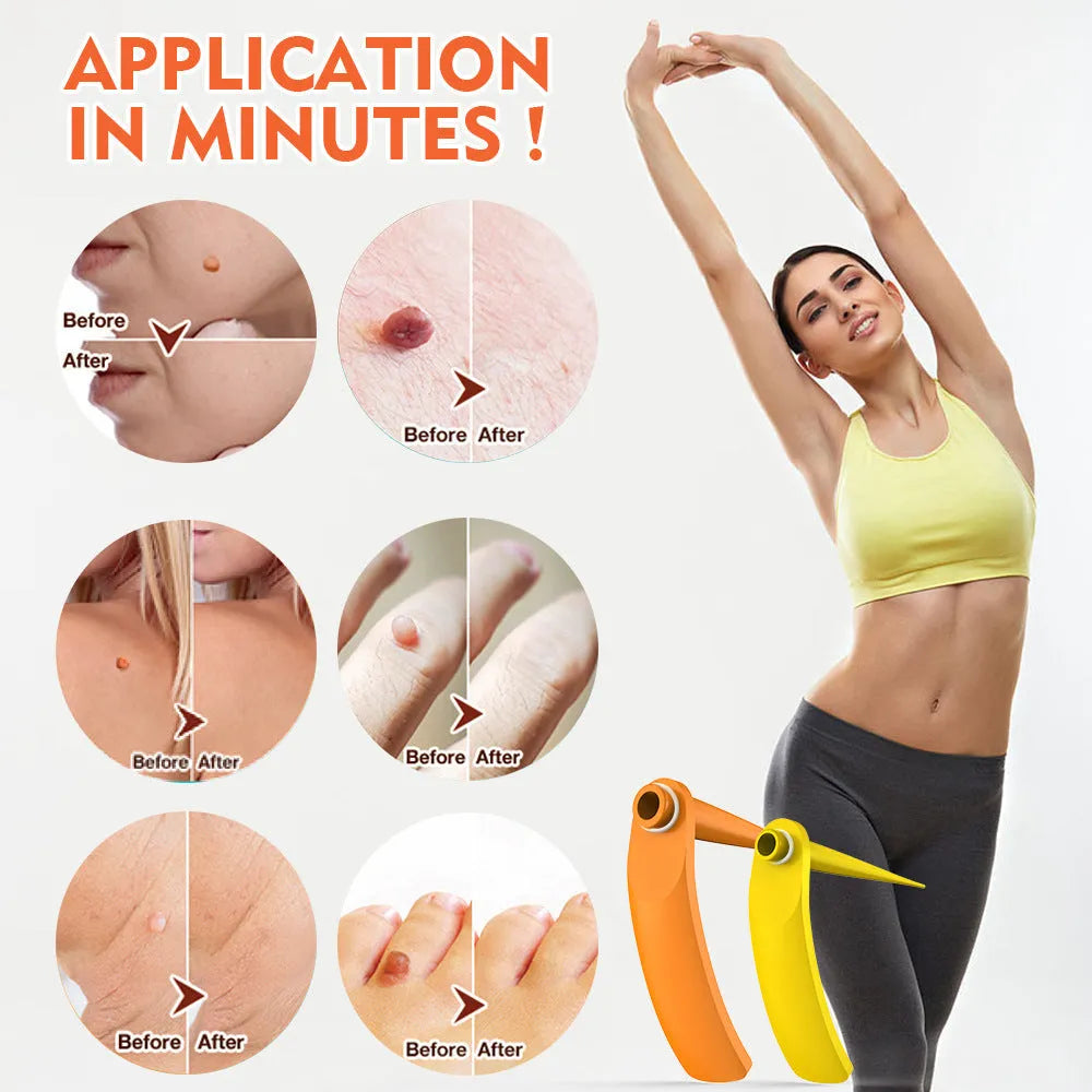 Orange yellow wart removal tool kit with devices, rubber rings, alcohol swabs, and stickers