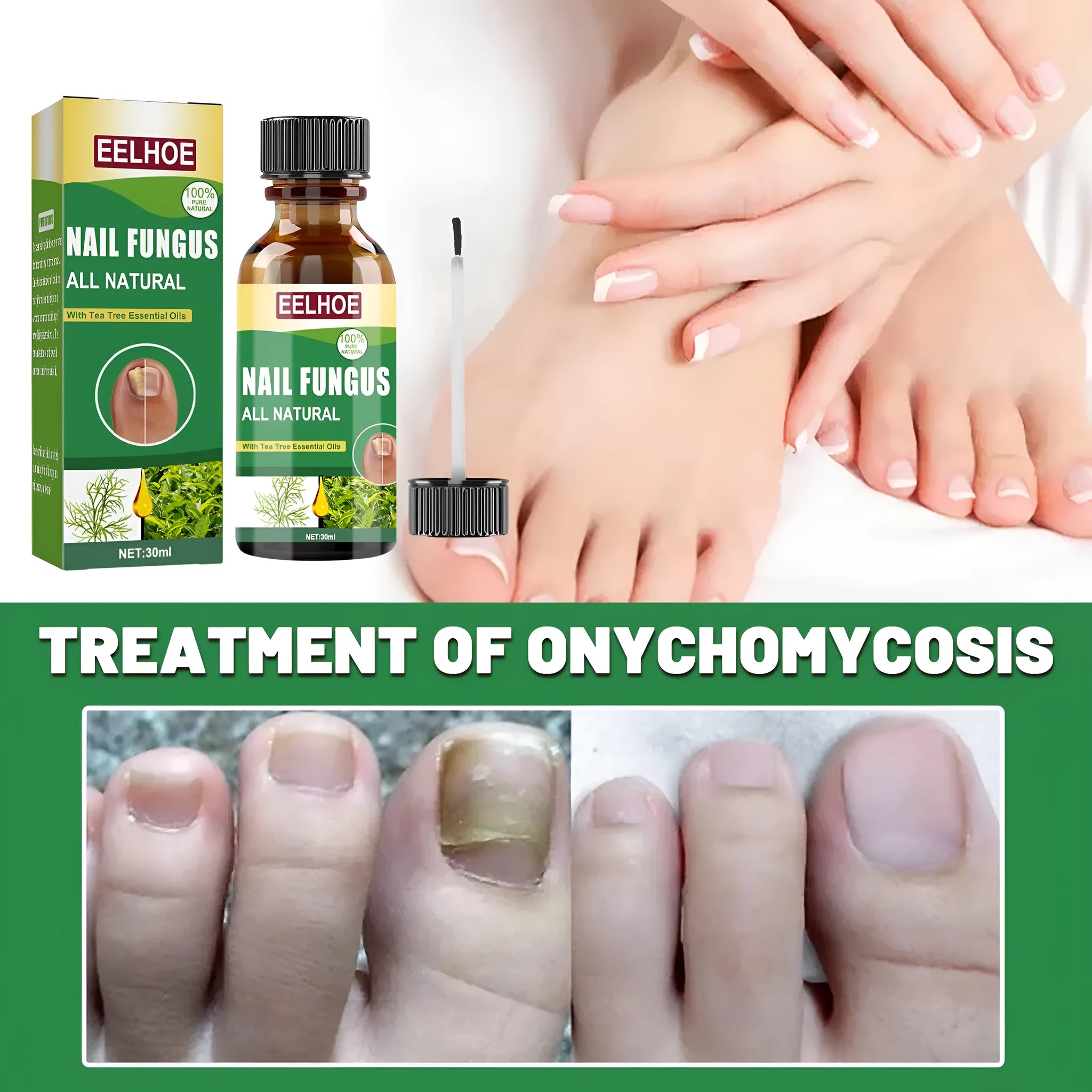 30ml tea tree oil nail repair treatment bottle for thickened toenails and fingernails
