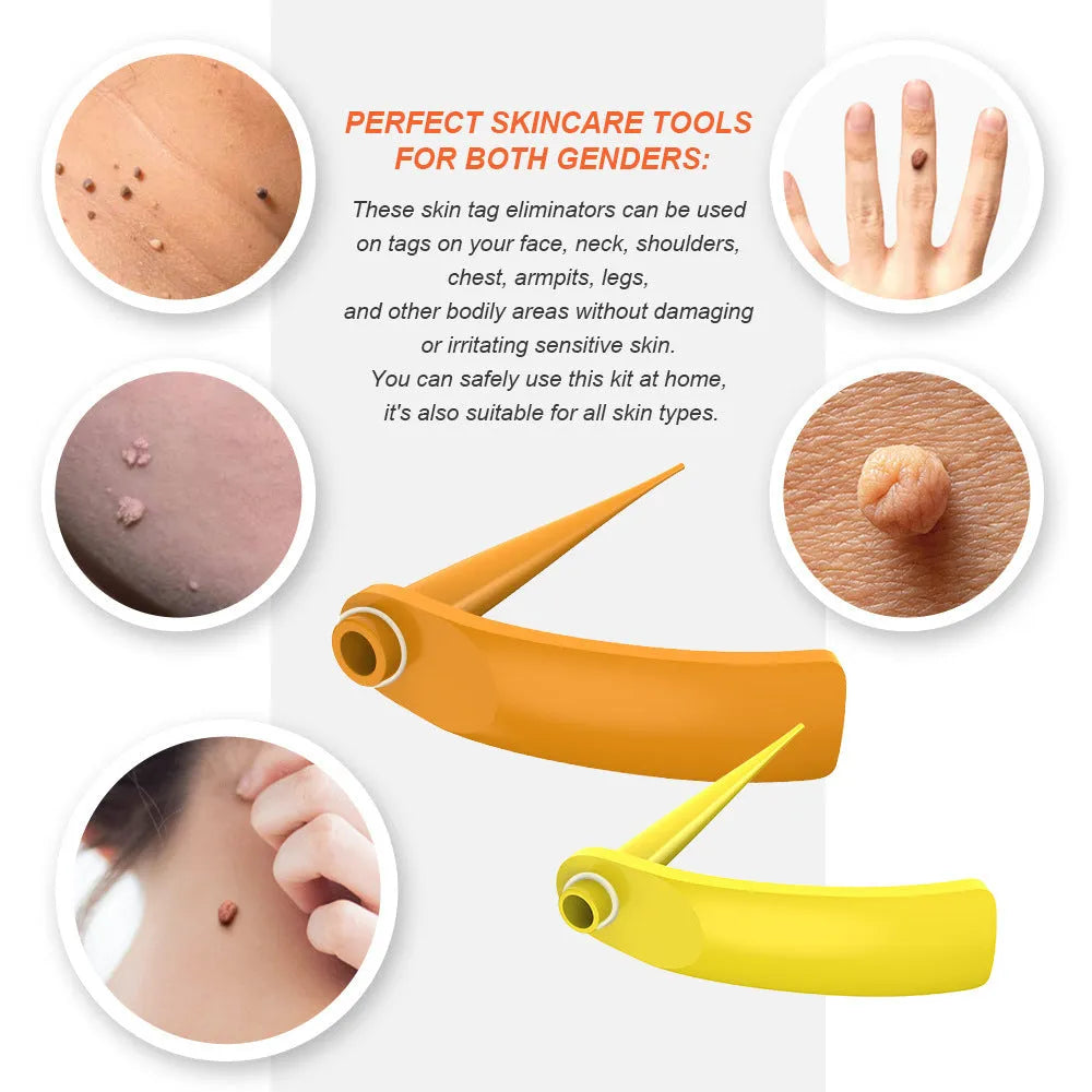 Orange yellow wart removal tool kit with devices, rubber rings, alcohol swabs, and stickers