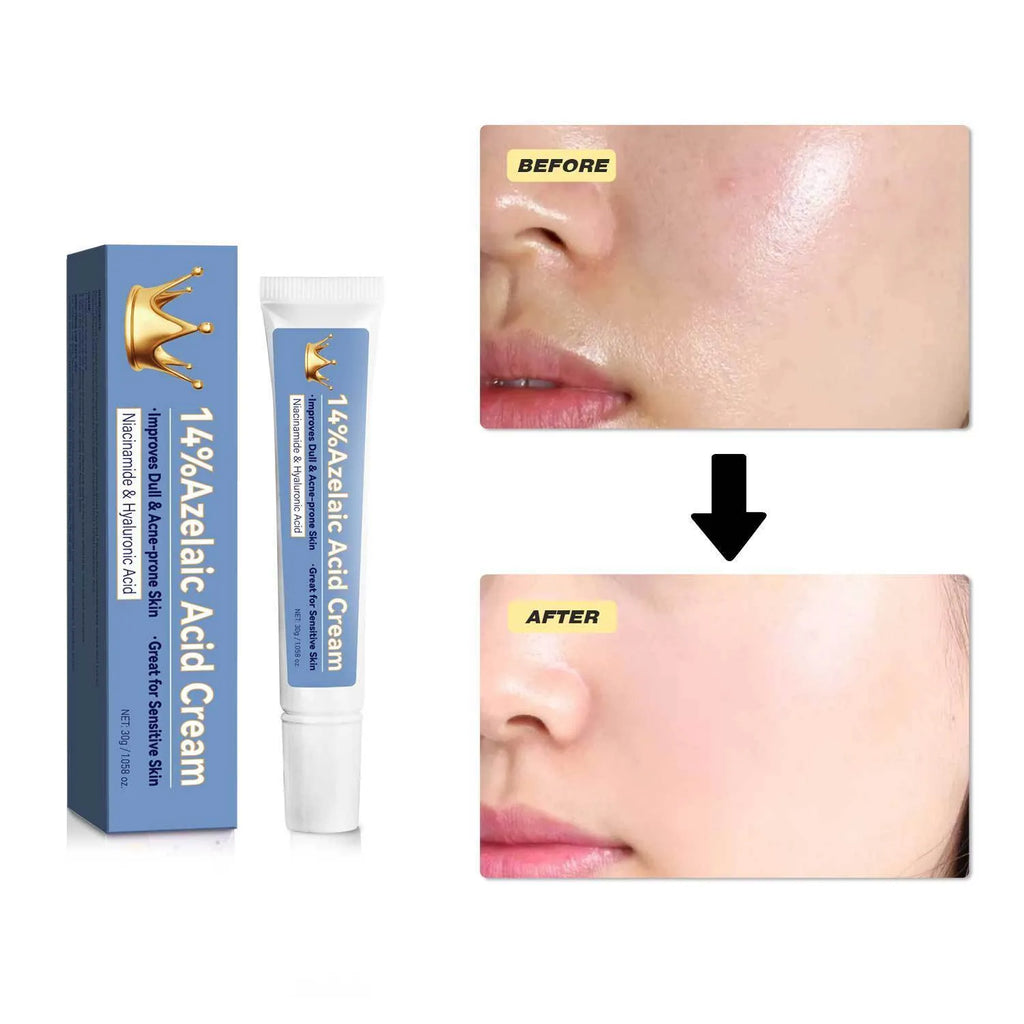Azelaic acid cream 30g tube in blue packaging with FPA035 label for general skin care treatment.